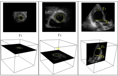 Figure 1. We present three slices of a 3D ultrasound volume of a left ventricle. We also show two curves the user draws on two parallel planes, these two curves will be the initialization of our model.