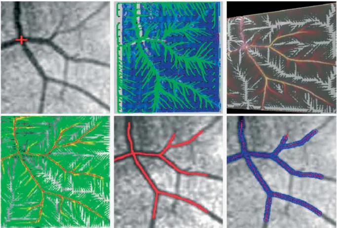 Figure 3. Vessel segmentation for a 2D retinal image with the geodesic voting method in augmented space