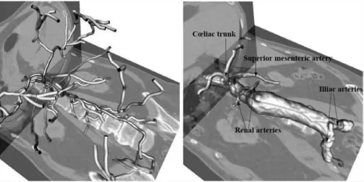 Figure 6. Deformable tube model: a closer look at the boundary surface. On the left, a representation with centrelines; on the right, slice of the 3D CT image, with centrelines and surface positions of two segments: aorta (bottom) and superior mesenteric a