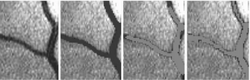 Figure 8. Blood vessels segmentation using the GVR and GVP methods from one of the 12 cropped retinal images (DRIVE data)