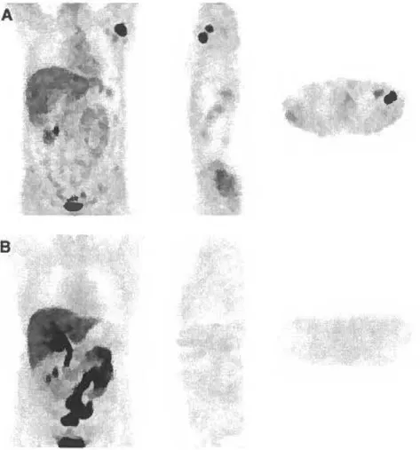 Figure 4. Discordant  18 F-FDG (A) and  18 F-FES (B) findings ln a patient with recurrent  breast cancer in the left axllla