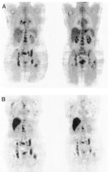 Figure 8. Patient recurrent metastatic breast cancer in the mediastinum and bones. The  18 F-FDG PET study (A) was obtained before (left) and after two months of aromatase  inhibitors (right) , with a moderate reduction in the metabolic activity of the les