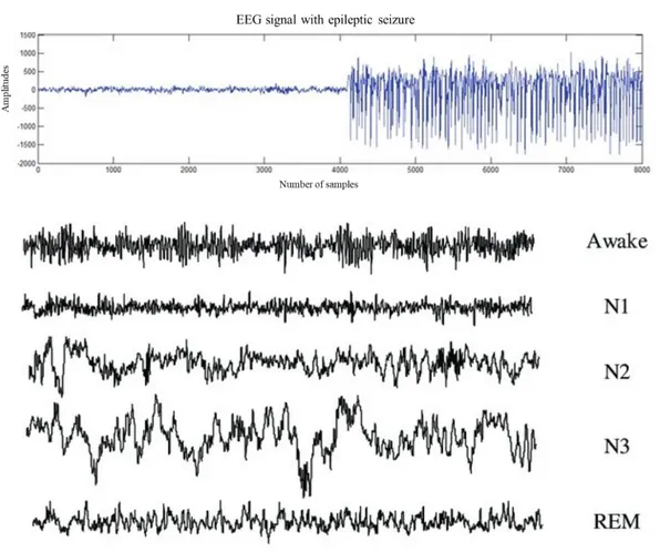 Figure 2.7 Top: EEG signal with epileptic seizure (adapted from Arunkumar et  al. [114])