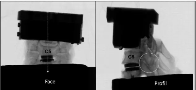 Fig 30 Radiographies de face et de profil du segment instrumenté. 