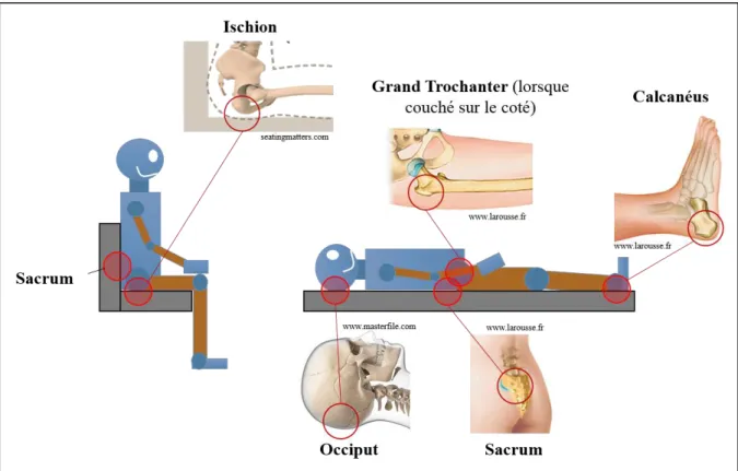 Figure 4 : Schéma représentant les régions anatomiques les plus touchées par l’escarre