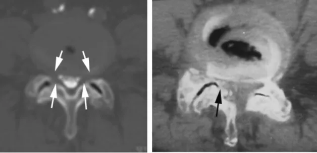 Fig.  5  Coupes  TDM  axiales  montrant  l’arthrose  des  articulaires  avec :  à  gauche  une  sténose  lombaire  par  bombement  discal  et  des  ligaments  jaunes  (flèches  blanches)  et  à  droite  une  compression par ostéophytes intracanalaires (flè