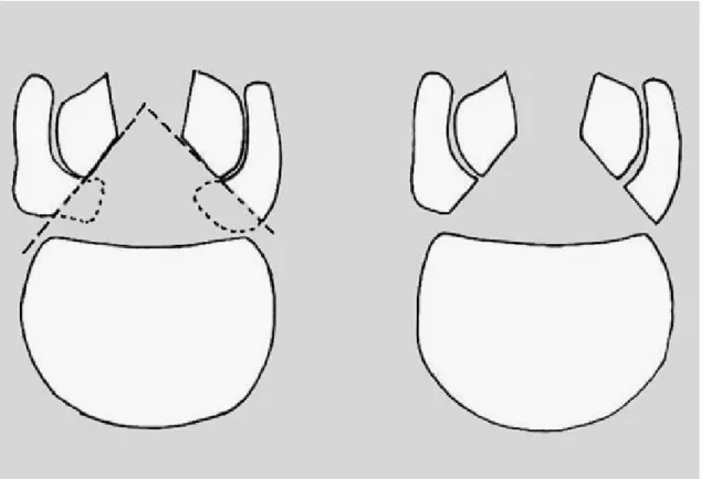 Fig. 7 Technique de libération de la sténose lombaire part lamino-arthrectomie. 