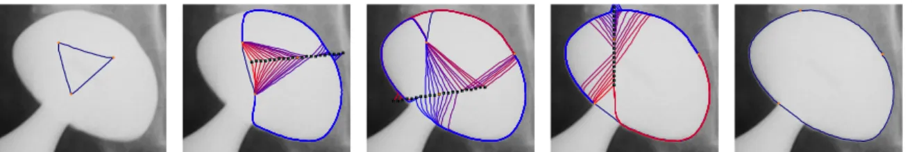 Figure 2: Evolution of geodesically linked active contour: in the evolution steps, all test geodesics from neighboring vertices to test positions in windows are represented.