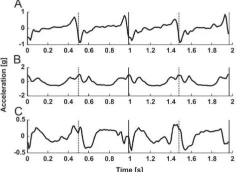 Figure  18:  Lower-back  acceleration  of  an  asymptomatic  person  while  walking  with  right  (vertical  solid  line)  and  left  (vertical  dotted  line)  heel  contacts