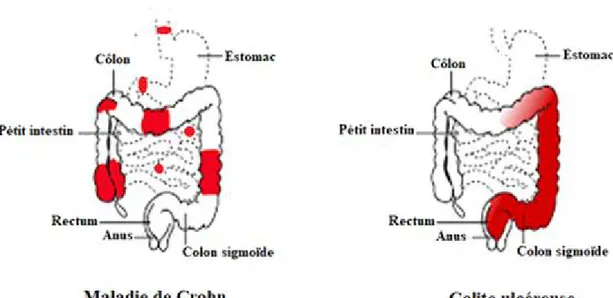 Figure 1.10 : Présentation générale des deux principaux types de maladies inflammatoires  chroniques de l’intestin