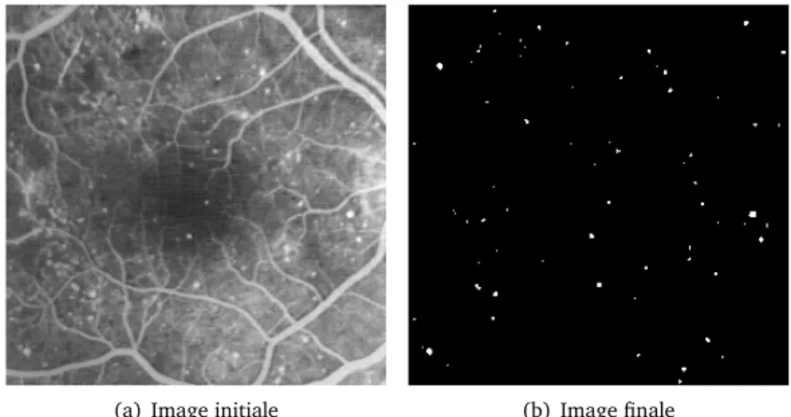 Figure 1.5 – Application de traitement d’images : détection de dégénérescence maculaire dans un fond d’œil