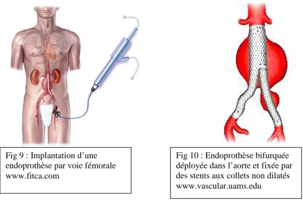 Fig 10 : Endoprothèse bifurquée  déployée dans l’aorte et fixée par  des stents aux collets non dilatés  www.vascular.uams.edu 
