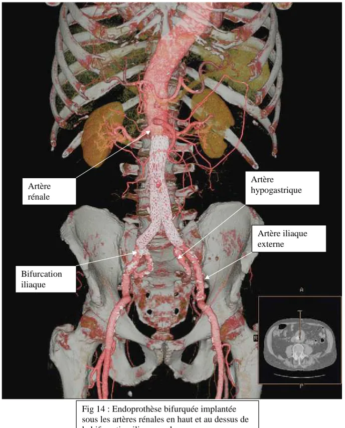 Fig 14 : Endoprothèse bifurquée implantée  sous les artères rénales en haut et au dessus de  la bifurcation iliaque en bas 