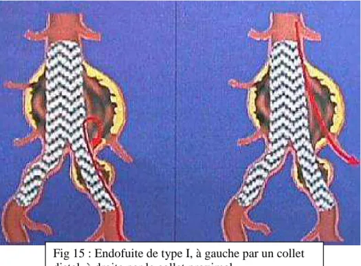 Fig 16 : Endofuite de type I proximal, fuite de produit  de contraste dans la poche anévrysmale 