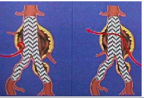 Fig 17 : Endofuite de type II par une ou plusieurs collatérales de l’aorte  www.unipv.it 