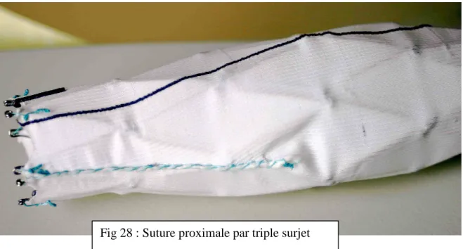 Fig 27 : Forme finale de l’ESM après  déploiementde la chaîne de stents dans le  fourreau de polyester calibré par suture  