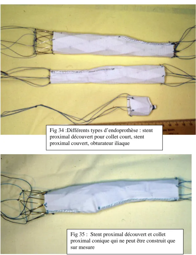 Fig 34 :Différents types d’endoprothèse : stent  proximal découvert pour collet court, stent  proximal couvert, obturateur iliaque 