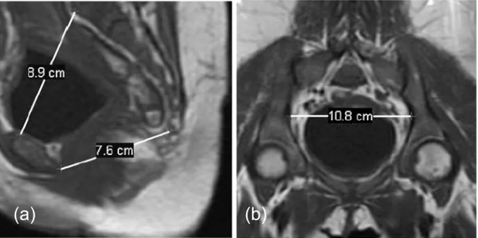 Figure 2 : Utilisation de l'IRM en pelvimétrie. (a) Section mi-sagittale : sont indiquées les distances  entre le promontoire sacré et le haut de la symphyse pubienne (8.9cm), et entre l’extrémité inférieure 