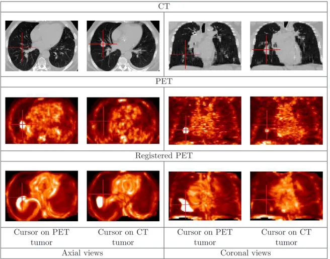 Figure 1.1: Result of the non-linear registration without tumor-based constraints. The absence of these