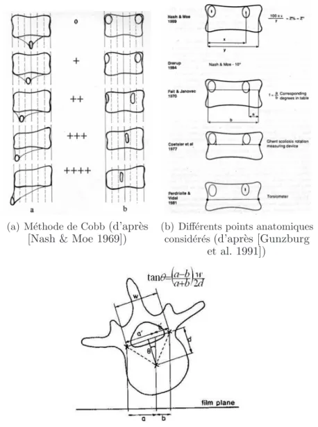 Fig. 2.5 – Mesures de la rotation axiale sur la radiographie frontale