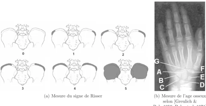 Fig. 2.6 – Analyses radiologiques compl´ementaires : ´evaluation de la maturit´e osseuse
