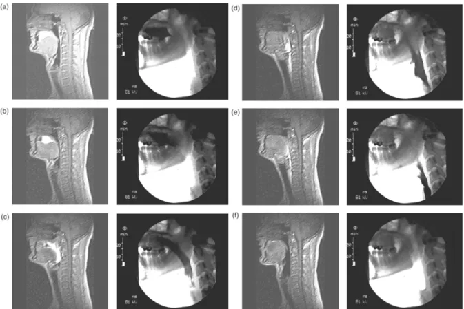 Figure 2.5. Les étapes importantes de la déglutition selon Buettner et al. (2001). 