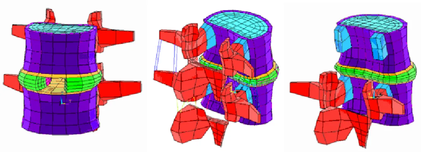 Figure 79 : Modélisation du geste chirurgical: discectomie, laminectomie, résection de l'arc  postérieur