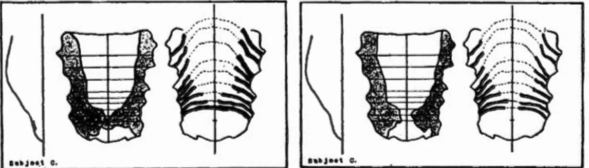 Figure  1.9  Palatogrammes de  [ts]  à gauche et de  [s]  à  droite (reproduit de  Haden ,  1941) 