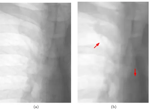 Figure 2.4: Image restoration in digital radiography: (a) detail of a CR image as- as-sumed to be noise-free; (b) image (a) restored with BM3Dc filter after simulating noise on to obtain a SNR equal to 15 dB