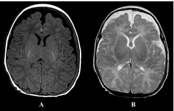 Illustration 7 : coupe axiale d'une IRM cérébrale néonatale normale pondérée en T1 (A) et en T2 (B) chez  un nouveau-né à terme
