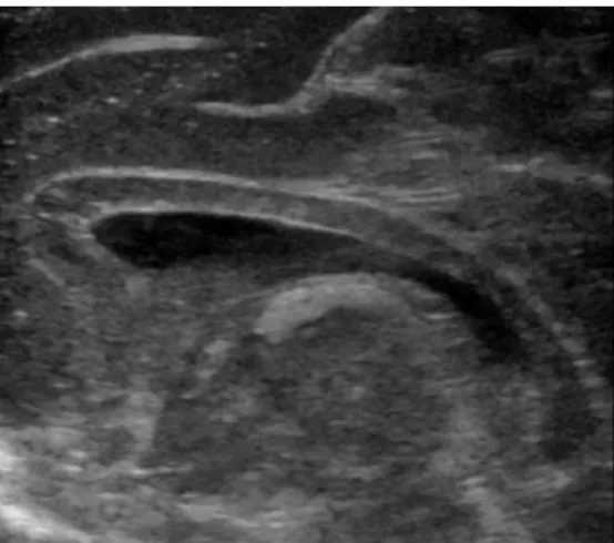 Illustration 11 : coupe sagittale normale du corps calleux lors d’une échographie transfontanellaire chez un  nouveau-né à terme