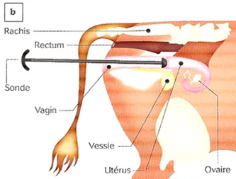 Figure 8 : Recueil du contenu vaginal à l’aide du dispositif  Metricheck®.  a. Sonde intravaginale Metricheck®  (Deguillaume)