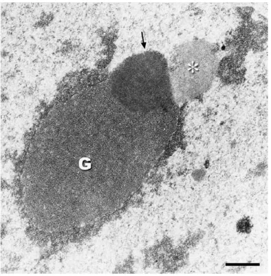 Figure  II-3 :  Désorganisation  du  nucléole  des  cellules  HeLa  observée  en  microscopie  électronique