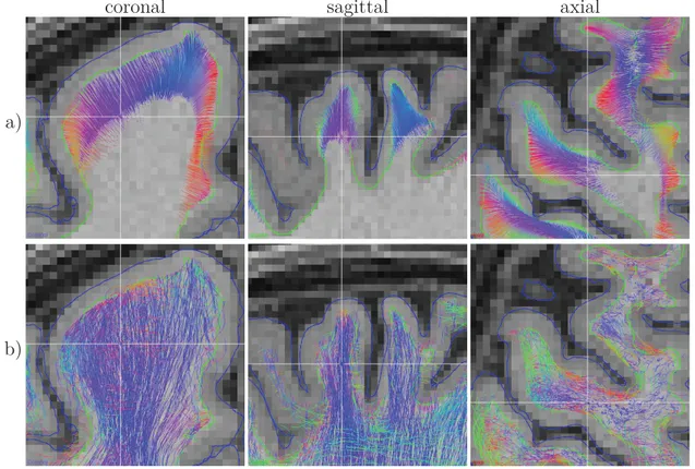Figure 3.5 – Visualization of the HCP subject tractography, seeded from the same surface points, over the T1 weighted image, colored by their local orientation  (left-right - red, anterior-posterior - green, inferior-superior - blue) : a) Positive constrai