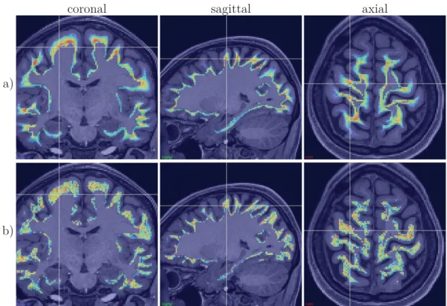 Figure 3.6 – Maps of the volume fraction of intra-cellular space, i.e. ﬁber density, as estimated in the superﬁcial white-matter with COMMIT using the streamlines recovered with : a) the positive constrained mass-stiﬀness ﬂow, b) the probabilistic local tr