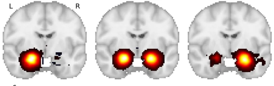 Figure 6.3: regression coefficients for “left amygdala”, “amygdala”, and “right amygdala”