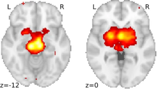 Figure 6.5: Map obtained for “Parkinson”, highlighting the thalamus, basal ganglia, and other subcortical nuclei involved in Parkinson’s disease (Davie,