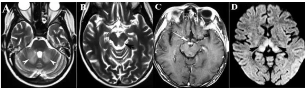 Figure 1.2: Image from Wikimedia Commons. Description: Brain MRIs demon- demon-strating hyperintense lesions in middle cerebellar peduncles on axial T2 weighted brain MRI (Part A), similar intensities in the tectum and tegmentum of  mid-brain on the left s