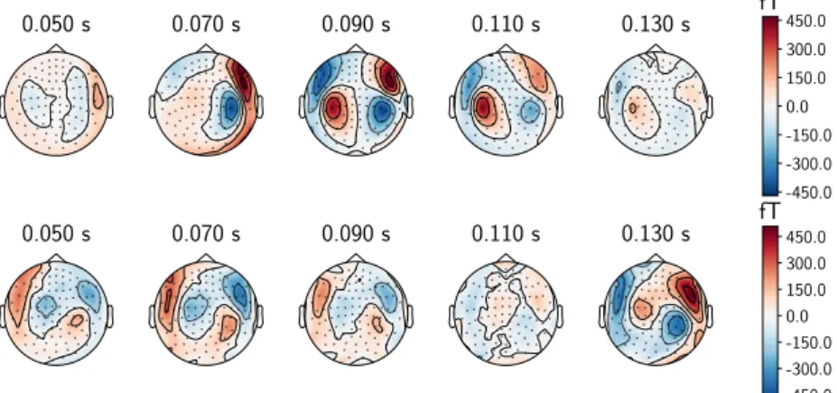 Figure 1.11 – Real (top) and simulated (bottom) magnetometers topographic maps. We simulate the activity of two dipoles in the left and right auditory cortex; the real topographic maps exhibits dipolar patterns similar to the simulated one, justifying the 