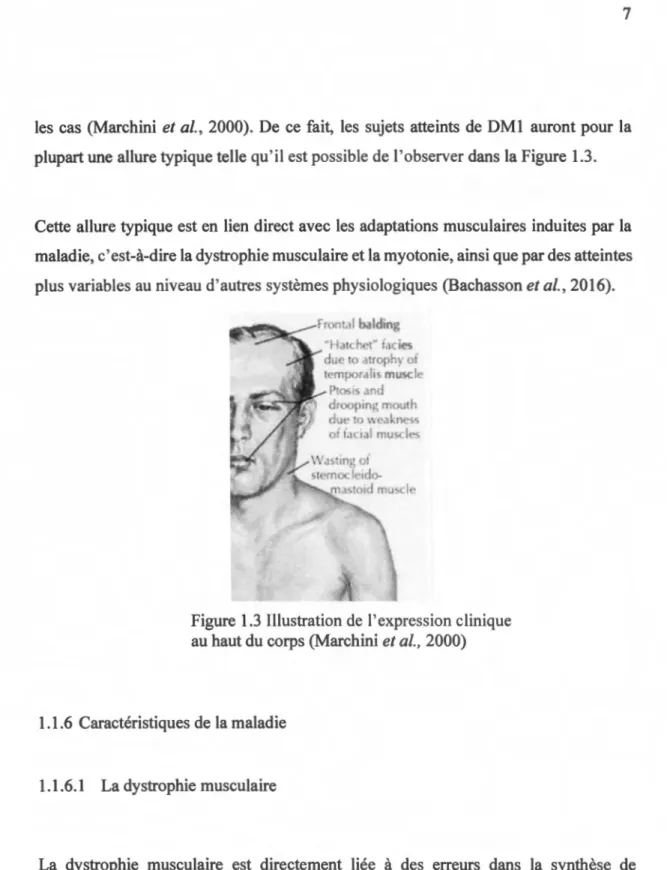 Figure 1.3 Illustration de  l'expression clinique  au haut du corps (Marchini  et al.,  2000) 