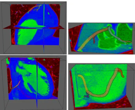 Fig. 7. First line : RCA segmentation using the tubular anisotropy approach shown on the whole image and on the selected sub-volume