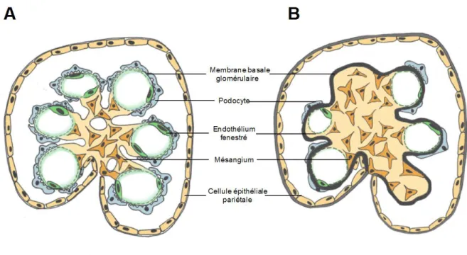 Figure 5 : Schématisation d’un glomérule normal et avec néphropathie diabétique  (A).  Représentation des structures d’un glomérule normal  (B)
