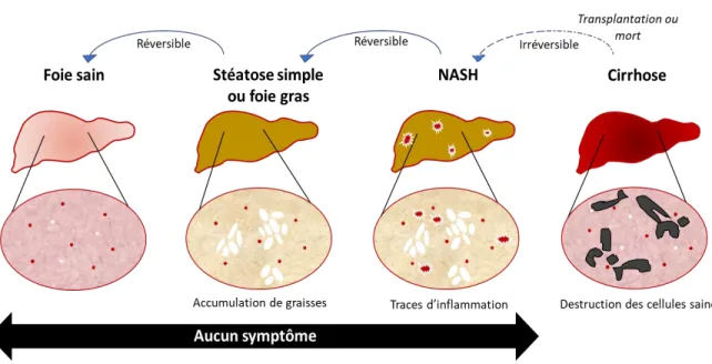 Figure 3: Progression de la stéatose hépatique (Source : adaptée de :BFMTV) 