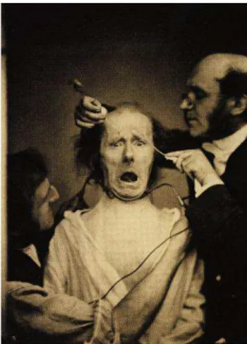 Figure 2 GB Duchenne déclenchement d'une expression de frayeur par stimulation électrique,   Domaine public : Mécanisme de la Physionomie Humaine (1862)