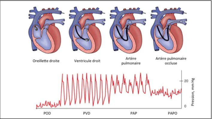 Figure  1.5 :  Cathétérisme  cardiaque  droit  –  insertion  de  la  sonde  et  tracé  de  pression  correspondant