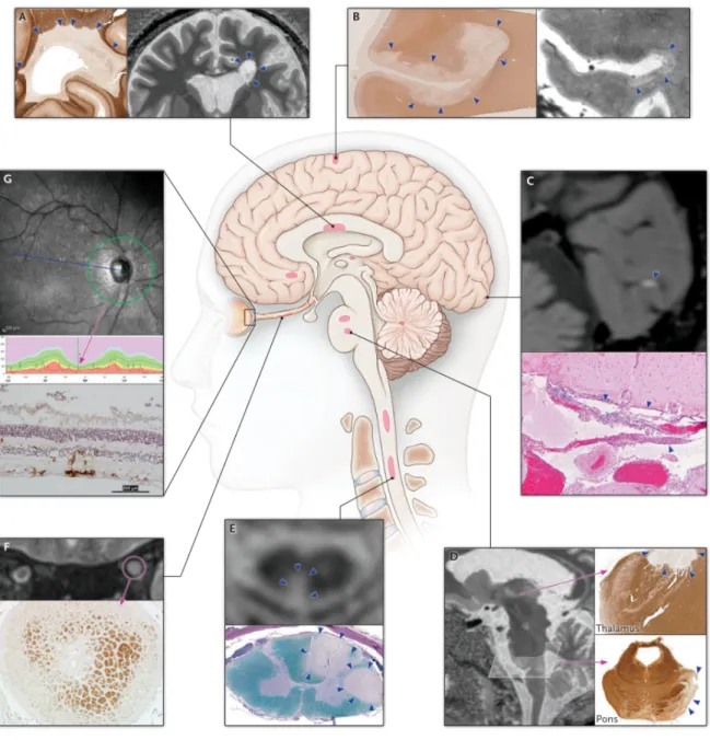Figure  1.2.  MS  lesions  at  CNS  sites.  A)  Periventricular  white  matter,  B)  subpial  cortex,  C) 