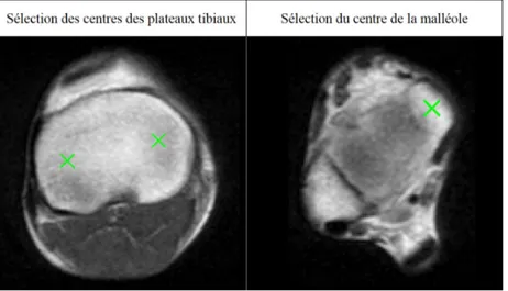 Figure III.8. Saisie des centres des plateaux tibiaux et du centre de la malléole pour la construction du repère tibia.