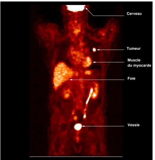 Fig. 1.6 – Un exemple d’image TEP. Les traceurs s’accumulent dans le cerveau, les tu- tu-meurs, le foie et la vessie.