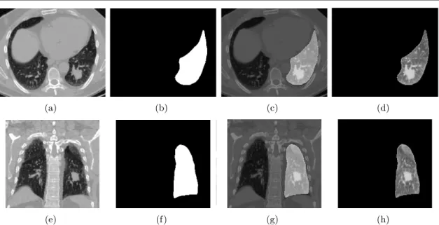 Fig. 2.5 – Application d’un masque pour la segmentation d’une tumeur: (a) et (e) image TDM du thorax avec une tumeur pulmonaire (coupe axiale et coupe coronale), (b) et (f) masque du poumon gauche, (c) et (g) superposition du masque et de l’image TDM, (d) 
