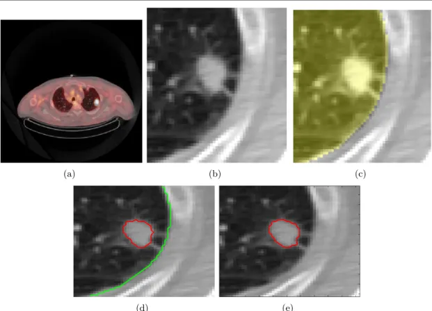 Fig. 2.7 – Segmentation d’une tumeur pulmonaire à l’aide de deux termes d’attache aux données différents